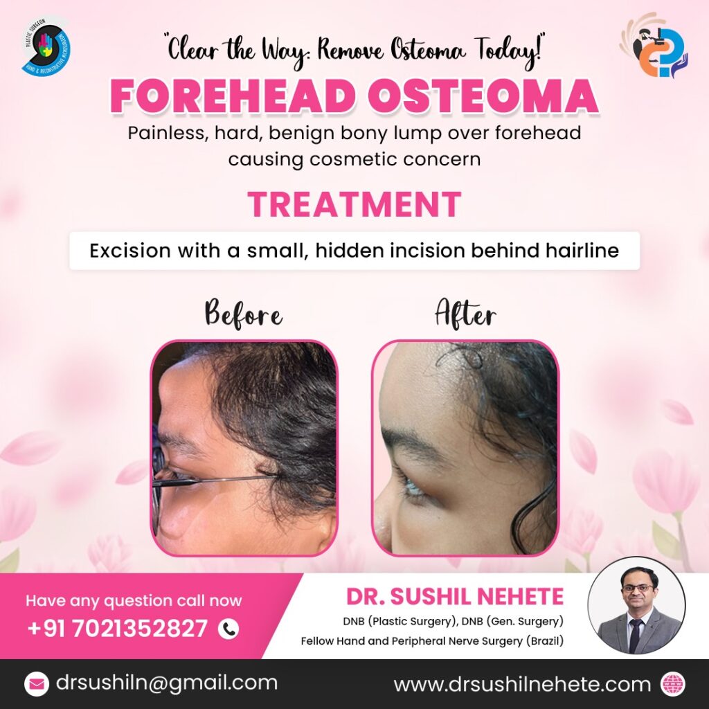 forehead-osteoma