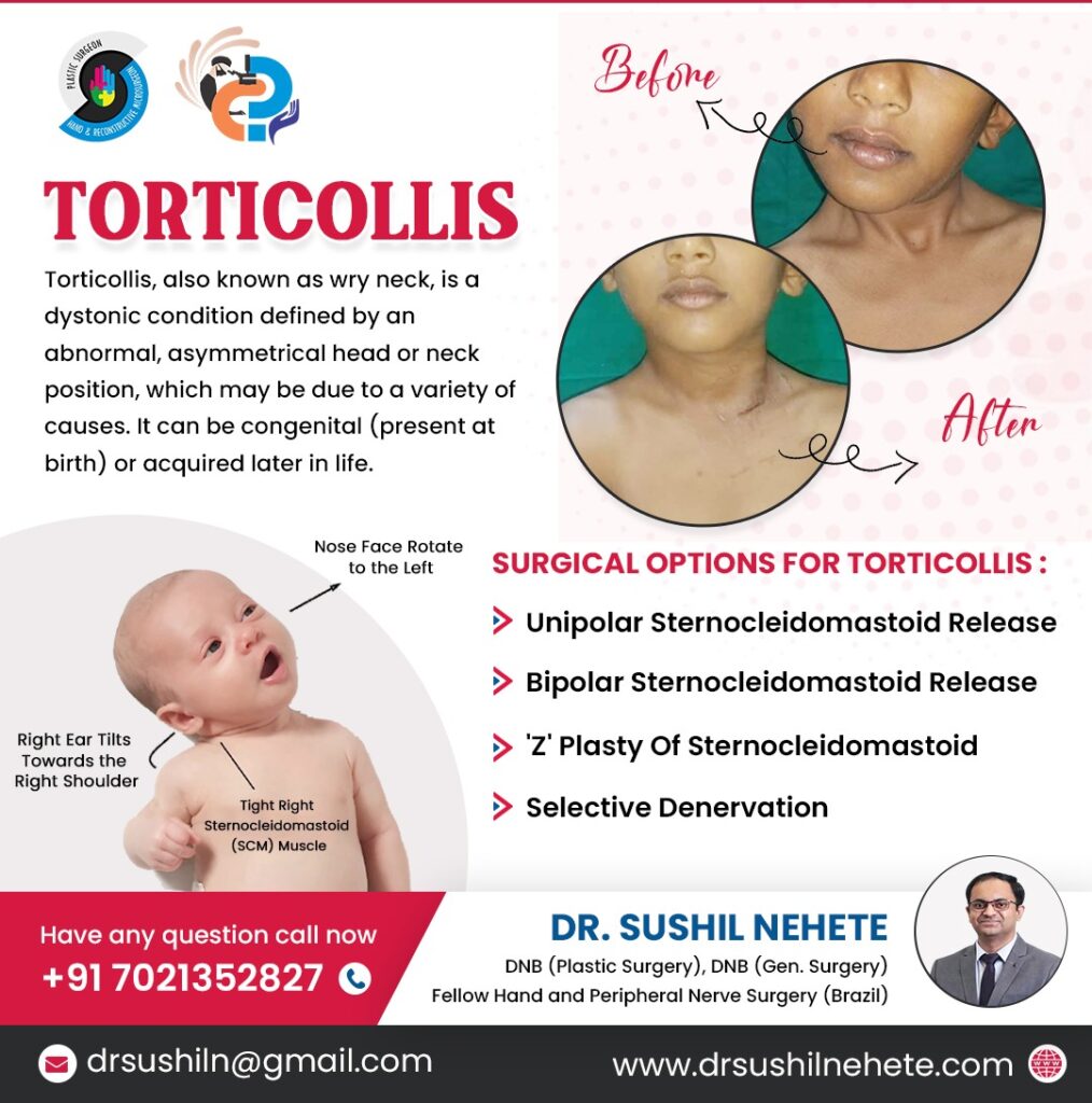 torticollis