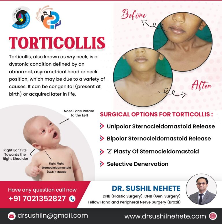 torticollis