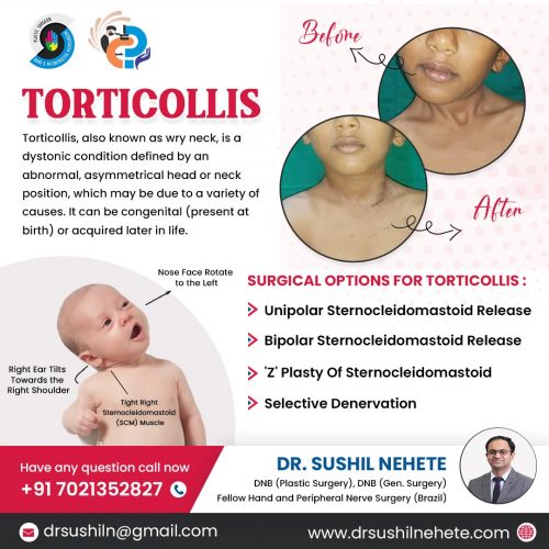 torticollis